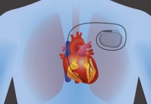 Plus de 8.000 vulnérabilités dans un pacemaker !